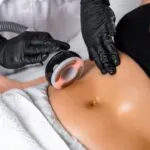 does cavitation liposuction deliver results facts and figures