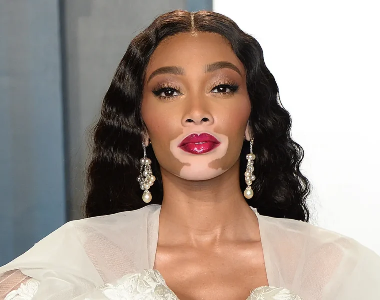 what is Winnie Harlow known for